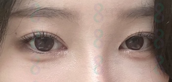 Eyelid Correction Surgery Review: Famous Eyelid Correction Clinic, Ptosis Surgery Before and After image 2