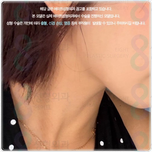 The Difference Between 300 and 600 Lines of Ultherapy: What to Check Before Comparing Lifting Costs image 2