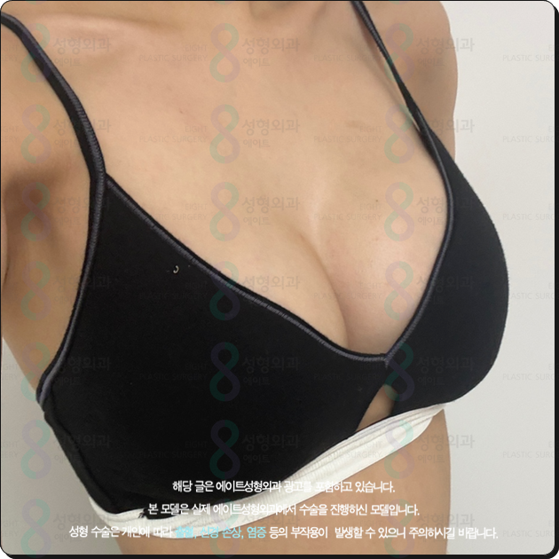 Breast Augmentation Surgery Cost (Price) and the Secret to a Review with No Side Effects Before and After? image 5