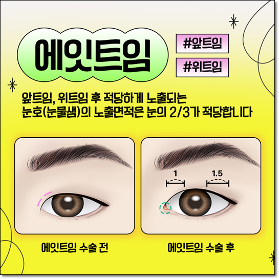 쌍커풀 수술을 고민하신다면? 매몰법의 전후 변화와 비용까지 꼼꼼히 체크하세요 관련 이미지 9