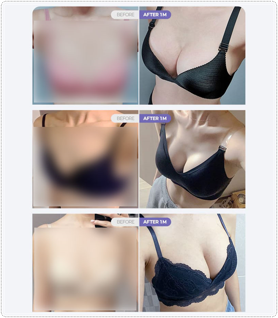 How to Find a Well-Known Breast Plastic Surgery Clinic in Seoul’s Gangnam District: Selection Criteria and Points to Check image 7