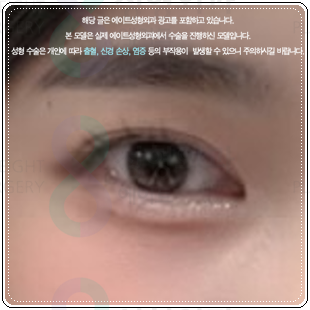 쌍커풀 하고 앞트임 수술을 해도될까? 쌍수 이후 라인 변화에 대해서 관련 이미지 3