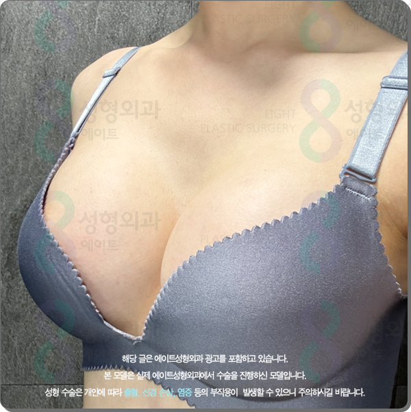 가슴확대 수술 어떤 보형물 종류로 해야 후기가 좋은가? (ps. 비용) 관련 이미지 2