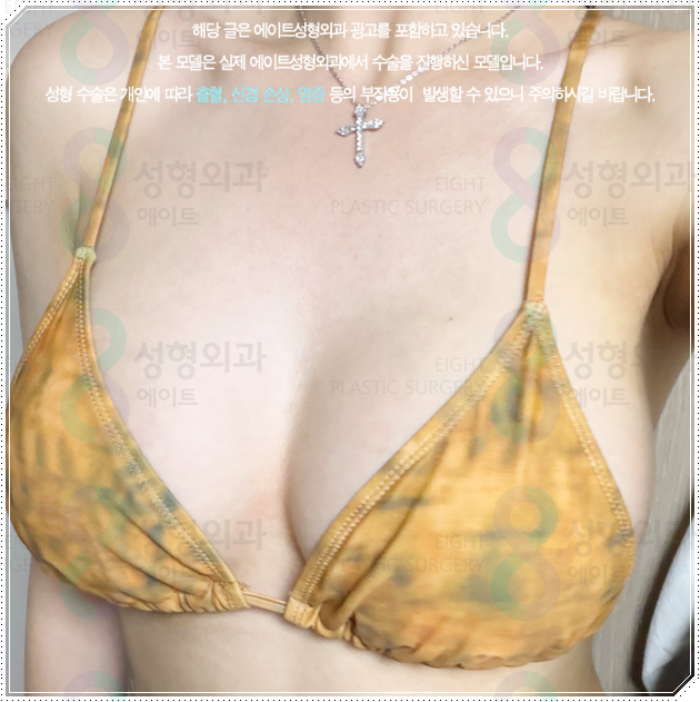 Why Do Breast Augmentation Surgery Prices Differ by Type, and How Can You Avoid Side Effects? image 2