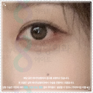 눈밑수술과 쌍꺼풀 같이해도될까? 눈밑지방재배치 쌍수 방법, 비용과 회복기간은? 관련 이미지 5