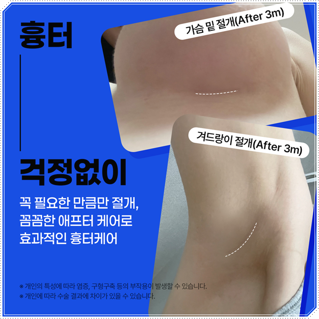 How Much Does Sagging Breast Surgery Cost? A Summary of Improvement Methods, Reviews, and Recovery Time image 7