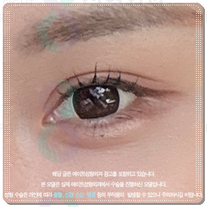 Why Choose Partial Incision Instead of Non-Incision Double-Eyelid Surgery? Meaning, Cost, and When Does the Swelling Go Down? image 5