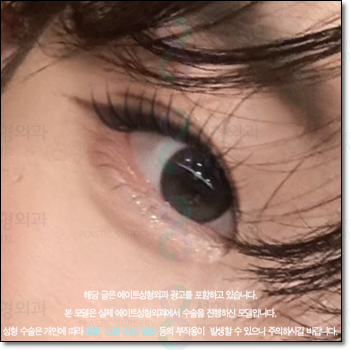 A Review of Upper Blepharoplasty Costs That Was Worth Every Penny! From How to Remove Mongolian Folds to Pricing and Recovery Care Tips image 3