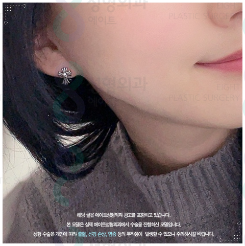 울쎄라 리프팅은 300샷으로 어느정도 효과가 있을까? 관련 이미지 2