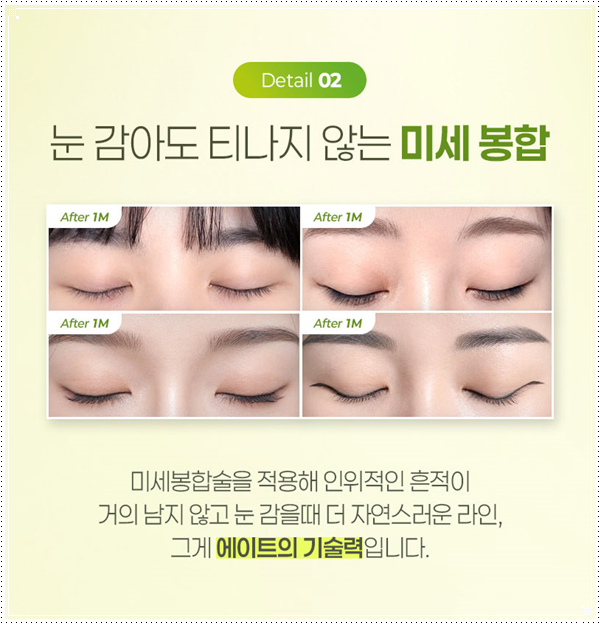 인라인 쌍꺼풀 후기, 쌍수 전과 1개월 후 라인은 어떻게 달라질까 관련 이미지 11