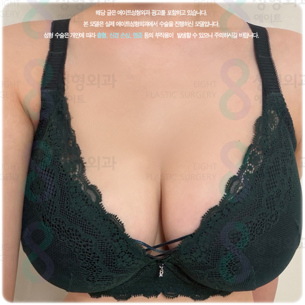 가슴확대수술, 후기와 비용·붓기·회복 기간은 어떻게 될까? 관련 이미지 2