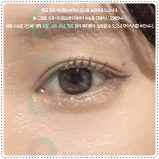 Natural Double Eyelid Surgery Using the Non-Incisional Method: A Budget and Consultation Guide for Middle School Students’ Eye Shapes Before and After Surgery image 3