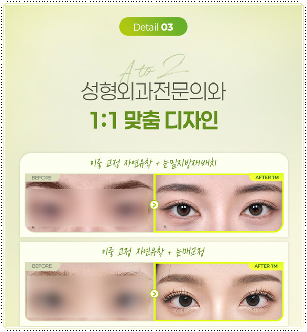 연예인 쌍꺼풀 종류? 평균 쌍커풀 수술비용 차이는 왜 나나요? 관련 이미지 11