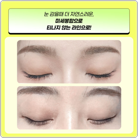 자연유착 매몰, 절개 차이 비교해봐요. 풀림 걱정없이 눈성형 비용과 후기 참고하는법 관련 이미지 8