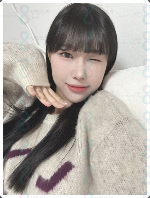 매부리코수술 비용, 왜 병원마다 차이가 날까? 관련 이미지 6