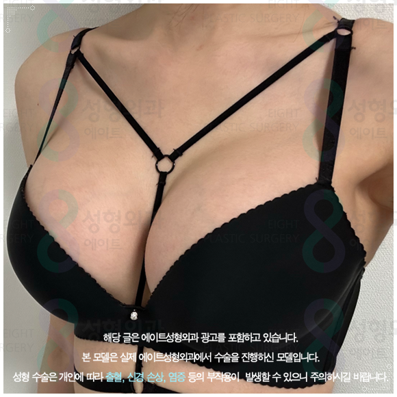 모티바 보형물이 가슴 수술의 가격 차이가 나는 이유? (부작용 증상을 낮추는법) 관련 이미지 1