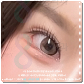 수술 가격이 다른 이유? 매몰과 절개 어떤 쌍꺼풀 재수술을 해야할까? 관련 이미지 1