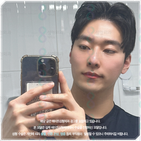 남자 코성형 종류 어떤 게 맞을까? 평균 비용부터 회복기간, 발품 팁까지 완벽 가이드 관련 이미지 2