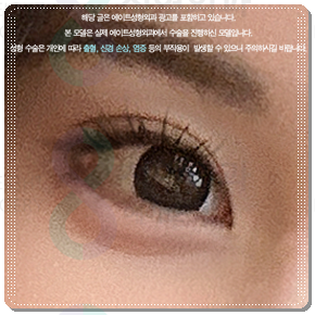 Ptosis Correction Cost: What Are the Criteria for Choosing Non-Incisional or Incisional Surgery? image 2