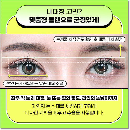 쌍커풀 수술을 고민하신다면? 매몰법의 전후 변화와 비용까지 꼼꼼히 체크하세요 관련 이미지 8