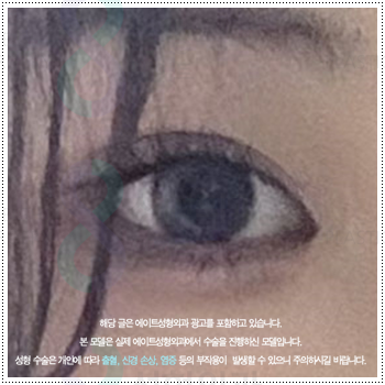쌍꺼풀 자연유착과 매몰, 절개 사이에서 고민이라면? 비용과 풀림 가능성을 낮추는 수술 방법은? 관련 이미지 2
