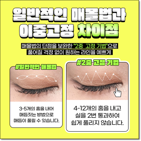 쌍커풀 수술을 고민하신다면? 매몰법의 전후 변화와 비용까지 꼼꼼히 체크하세요 관련 이미지 7