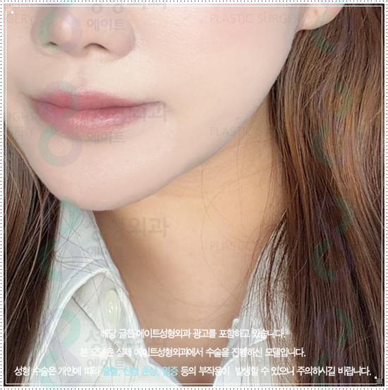 When Do Ulthera Results Actually Appear? Post-Treatment Care and Pricing by Timing image 2