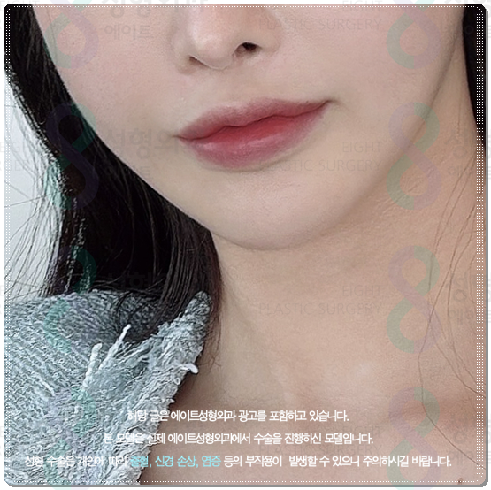 Gangnam) How Much Does 300 Shots of Ultherapy Cost? Treatment Time, Frequency, and Before-and-After Results (Ultherapy PRIME) image 5