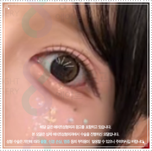 자연유착 쌍꺼풀 수술 후기 | 압구정 쌍수 밑트임 후 붓기 한달 변화 참고 후기 관련 이미지 4