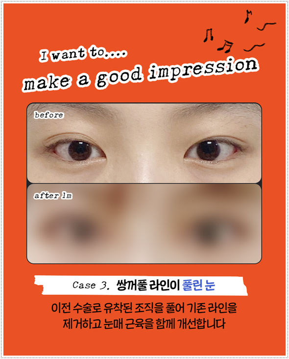쌍커풀재수술 절개쌍수 말고 매몰은 못하나? 재수술 시 가격 얼마? 관련 이미지 12