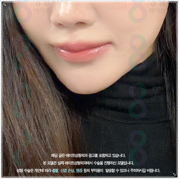 처지는 피부 고민? 리프팅 중 울쎄라 100샷은 300샷과 가격이나 효과가 많이 다른가요? (울쎄라피프라임) 관련 이미지 4