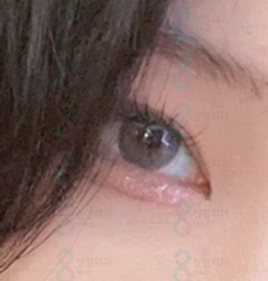 Hospitals That Are Good at Eye Plastic Surgery, Places That Are Good at Double Eyelid Surgery, Gangnam Places Good at Double Eyelid Surgery image 2