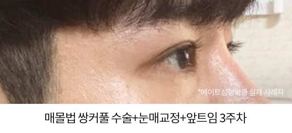 남자눈성형전후 비교해본다면 관련 이미지 2