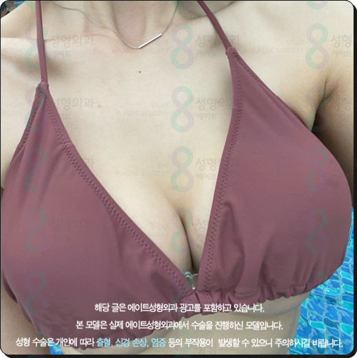 Motiva Breast Augmentation Cost (Price), Before-and-After Reviews: Can the Risk of Surgery Side Effects Be Reduced? image 3