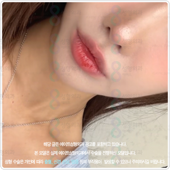 What Is the Difference Between 100 Shots and 300 Shots of Ulthera? Let’s Also Look at Ultherapy Prime Pricing and When Lifting Effects Appear image 3
