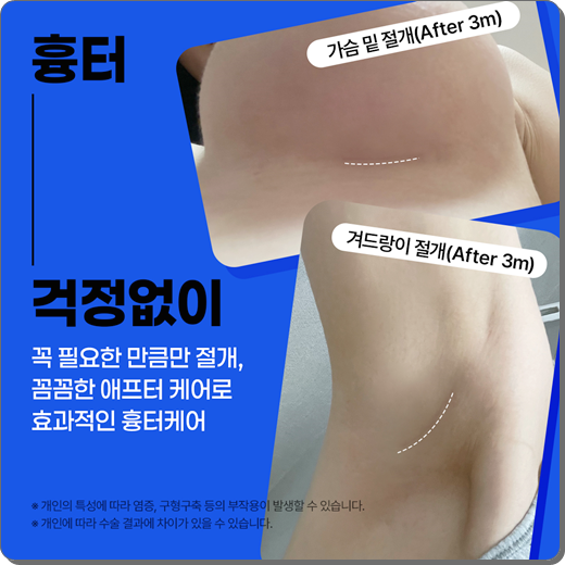 가슴 보형물 종류 모티바 특징 무엇인가요? 관련 이미지 16