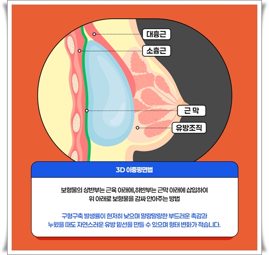 가슴확대수술비용 차이는 왜 나나요? 관련 이미지 13