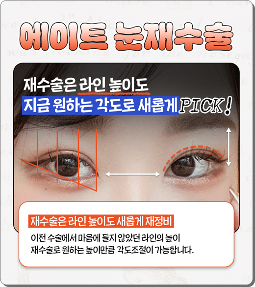 실패 없는 쌍꺼풀 재수술을 위해: 매몰법 특징부터 비용, 시기별 붓기 회복 과정 관련 이미지 15