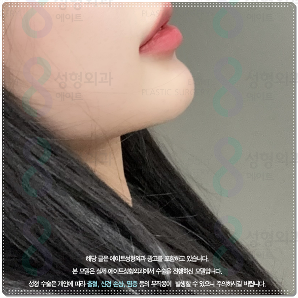 울쎄라 턱살에 효과 언제부터 있나요? (300샷 기준의 가격 평균은?) 관련 이미지 2