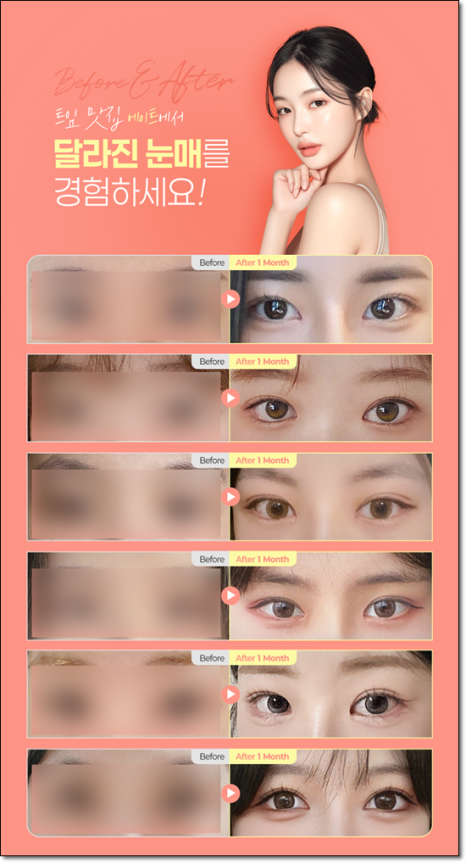 A Review of Upper Blepharoplasty Costs That Was Worth Every Penny! From How to Remove Mongolian Folds to Pricing and Recovery Care Tips image 6