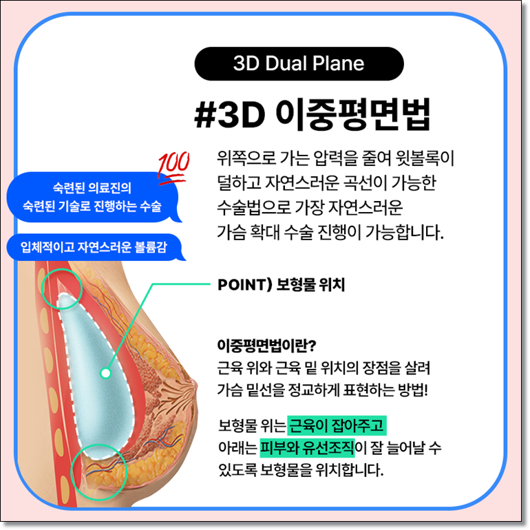 멘토엑스트라스무스 어떤 보형물인가요? 관련 이미지 6