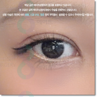 쌍수 가격은 평균적으로 얼마일까요? 매몰과 비절개? 절개 차이점까지 관련 이미지 5