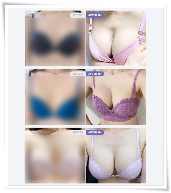 가슴성형 시 사용되는 보형물 종류와 가격 차이는 왜 생기나요? 관련 이미지 11