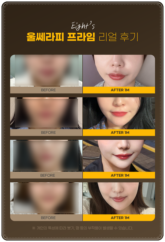 How to Choose a Clinic and Check Prices When Looking into Ulthera in Apgujeong image 6