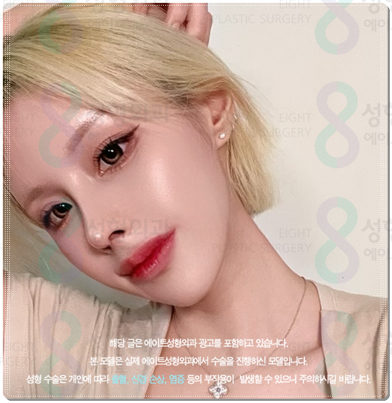 How Much Is a Reasonable Cost for Non-Incisional Ptosis Correction to Escape Sleepy-Looking Eyes? (Including the Differences from Incisional Surgery and Recovery Time) image 2