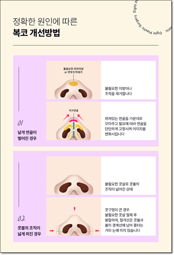 남자와 여자 차이? 매부리코는 수술 가격이 다를까요? 관련 이미지 10