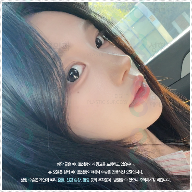 What Types of Rhinoplasty Are Available in Apgujeong? A Look at Bridge and Tip Surgery Prices and Recovery Times image 2