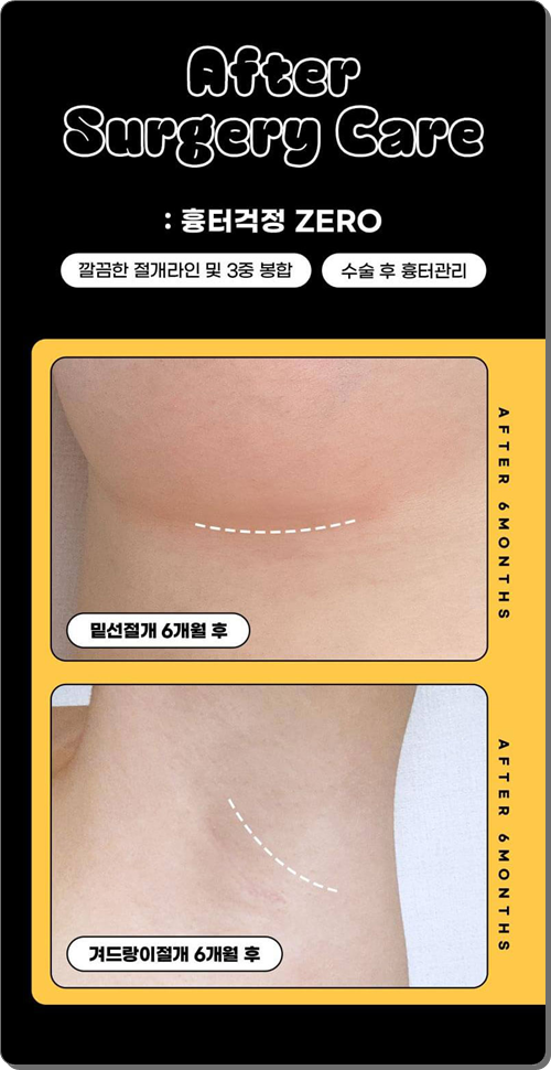 가슴성형 보형물 종류, 교체, 제거 시 모티바 보형물 재수술 알아보는 이유 관련 이미지 8