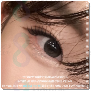 How Much Does Non-Incisional Double-Eyelid Surgery Cost? Comparing Suture and Incisional Methods image 1