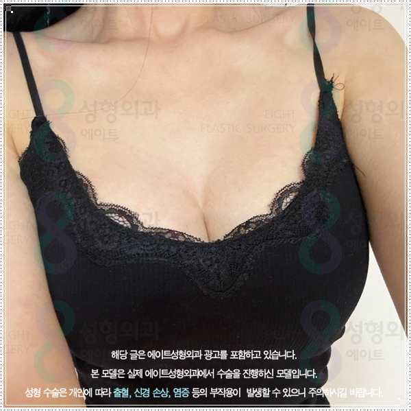 멘토 부스트 평균적인 가격, 작은 가슴 키우는 성형 방법과 수술 후 회복은? 관련 이미지 6